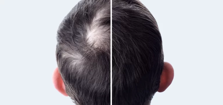 a man's hair after prp treatment and hair transplant