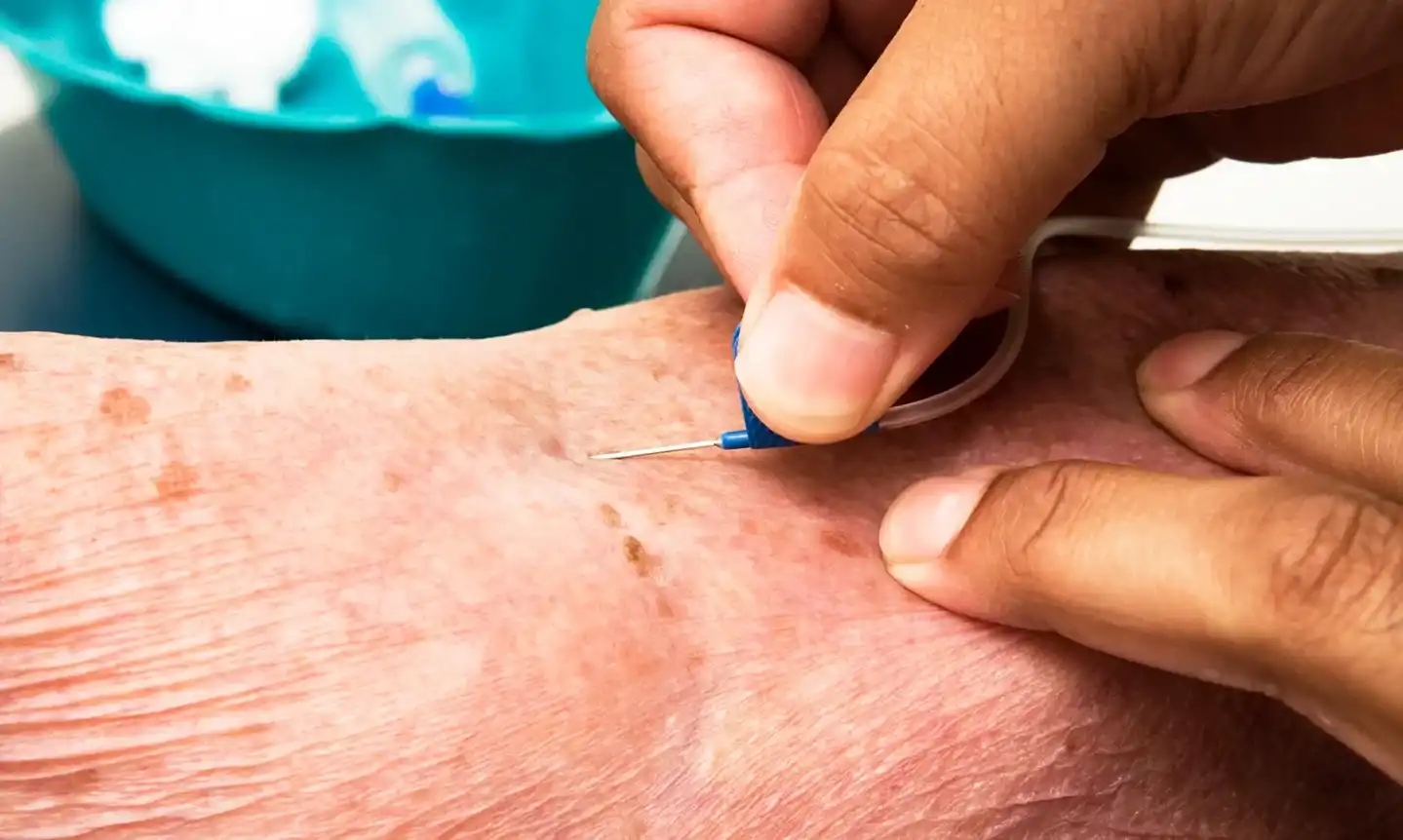 finding a vein using butterfly needle