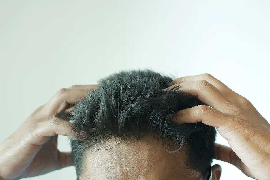 itching after exosome hair loss treatment