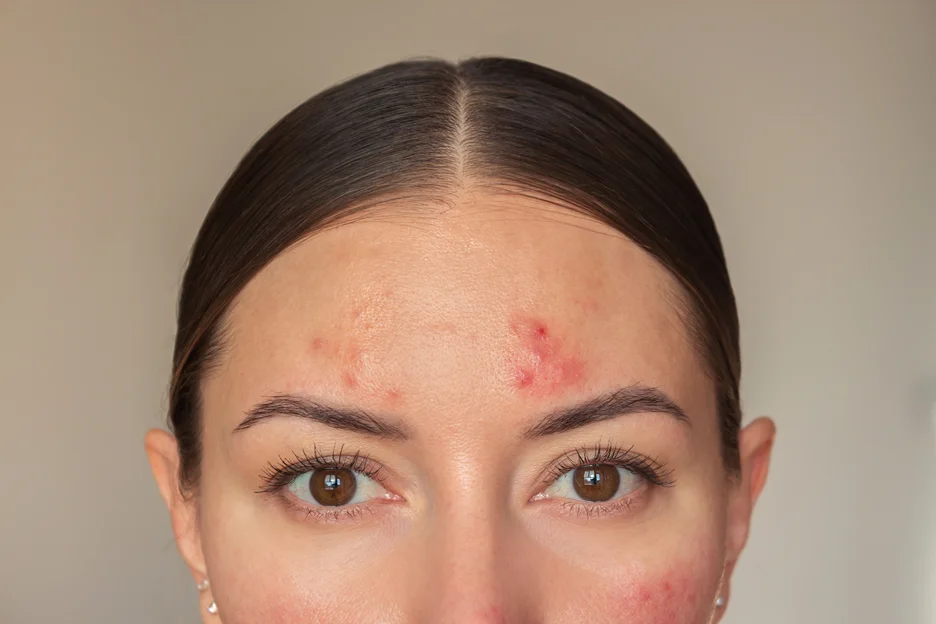 a woman with acne scars on her forehead and face