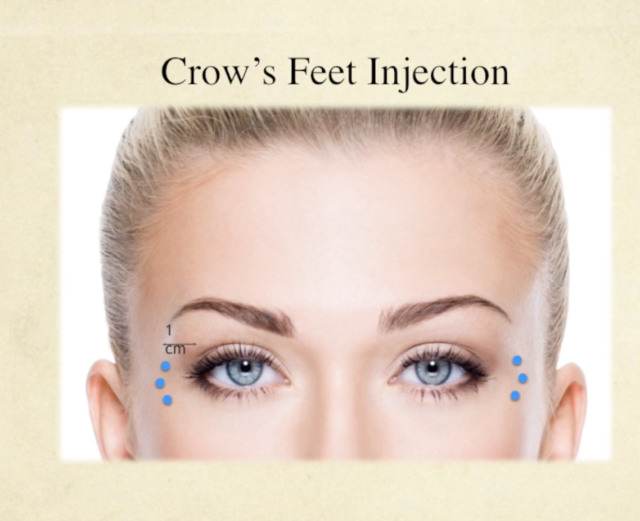 Facial Neuromodulator Injections Course - Image 7