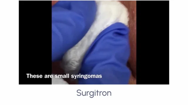 Surgitron - Image 2