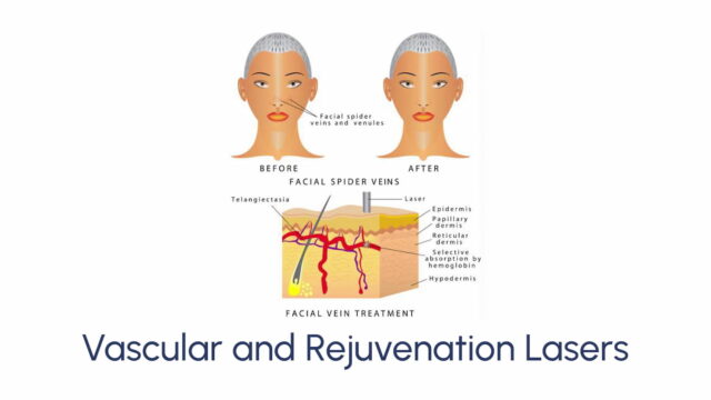 Vascular and Rejuvenation Lasers - Image 4