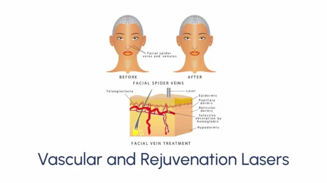 Vascular and Rejuvenation Lasers - Image 2