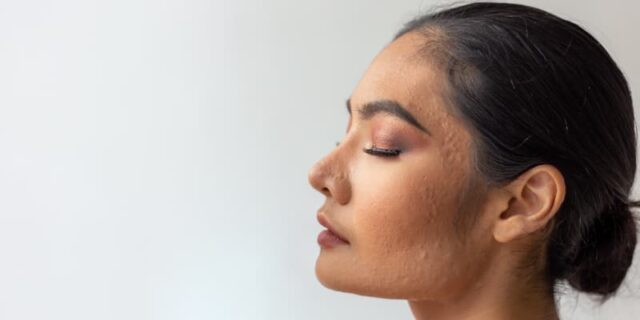 Acne Scars - Image 2