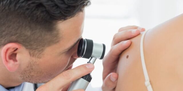 Cosmetic Mole Removal - Image 2