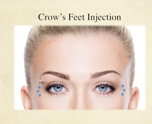 Facial Neuromodulator Injections Course - Image 4