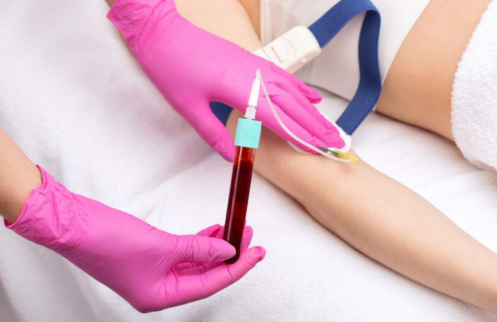 The procedure for taking blood from a vein to separate blood plasma in a centrifuge for PRP hair treatment