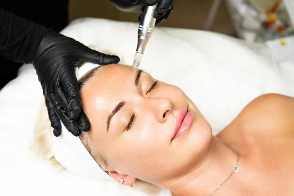 a woman underwent salmon dna microneedling treatment
