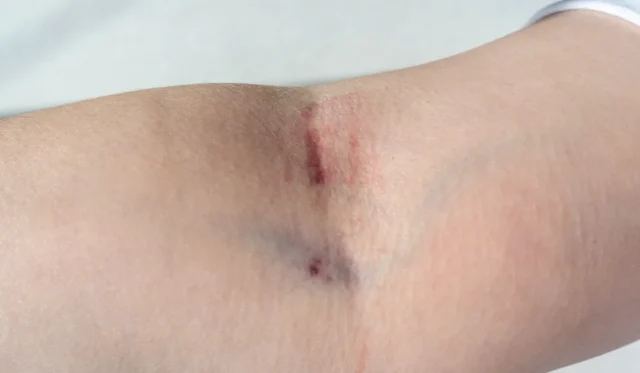 swollen injection site